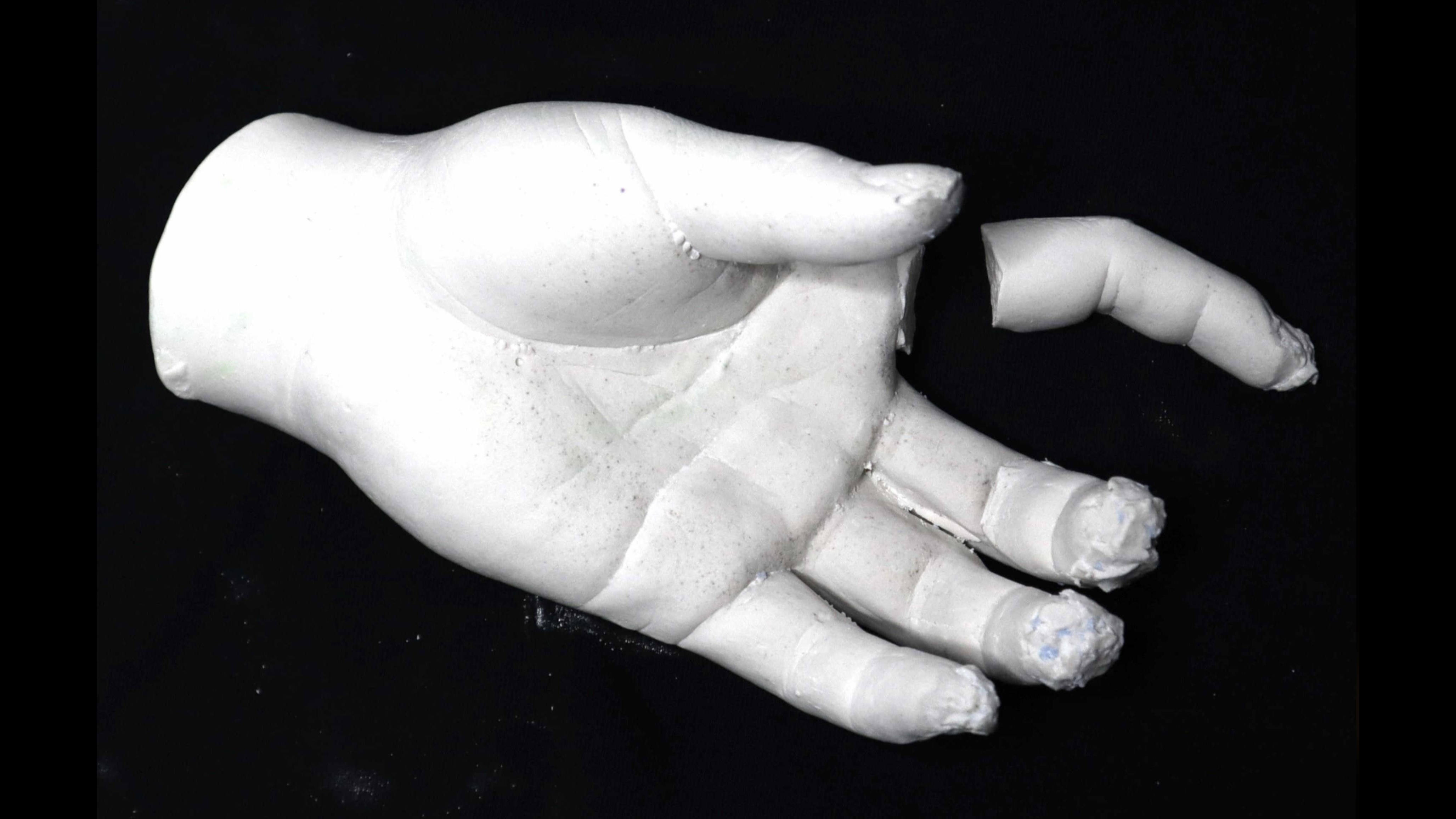 View of the plaster cast of my hand with one finger broken off.